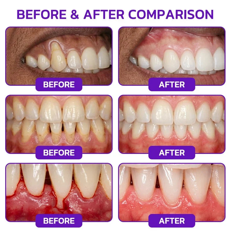 🦷VioCore Bee Venom Gingivitis & Periodontitis Treatment Toothpaste