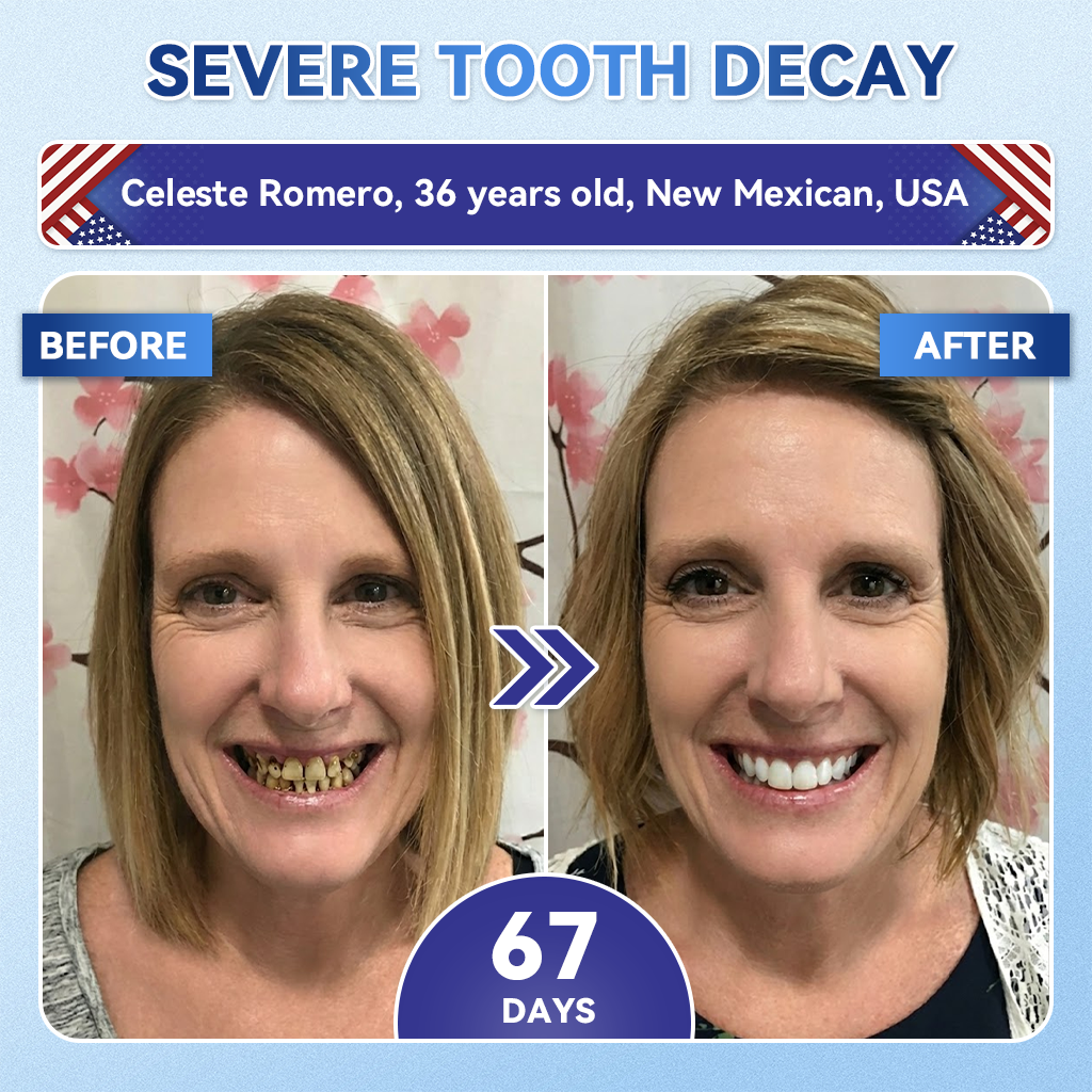 Dewvely® 🦷 Tideglusib Fast‑Dissolving Tooth & Gum Repair Oral Strips ✨