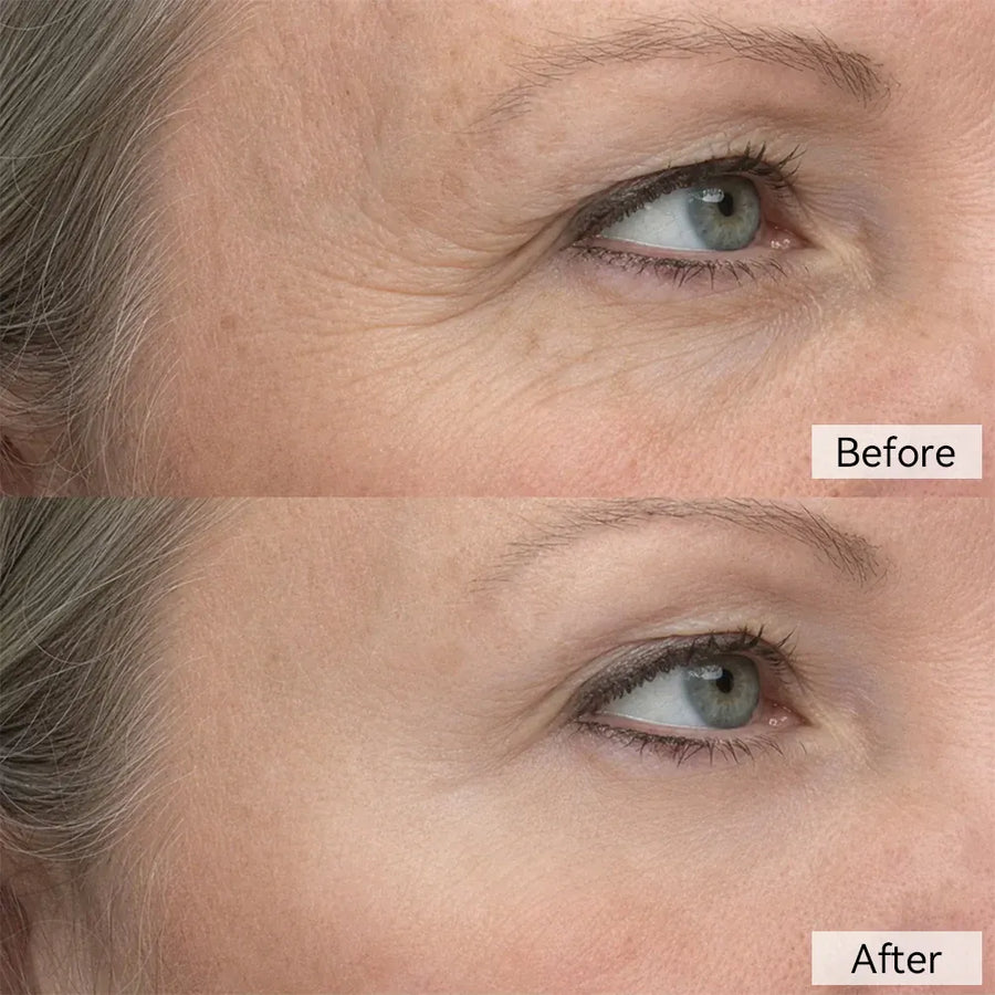 Her Concern: Dark Circles - after