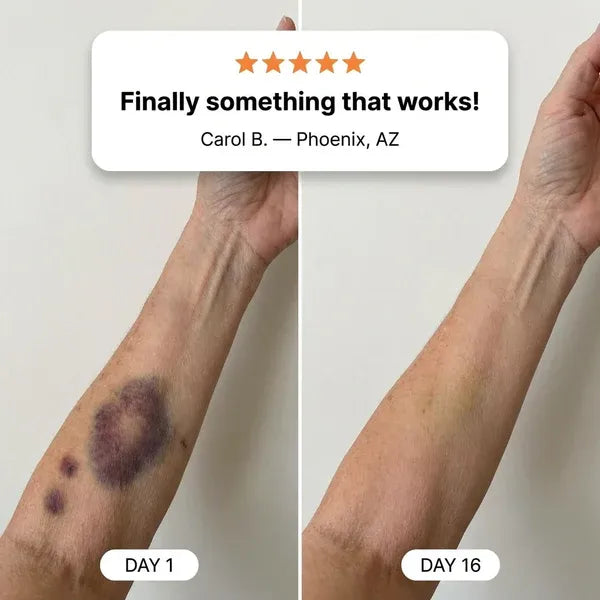 💥100K+ SOLD💕- Nysvira™ Bruise Repair & Skin-Strengthening Cream